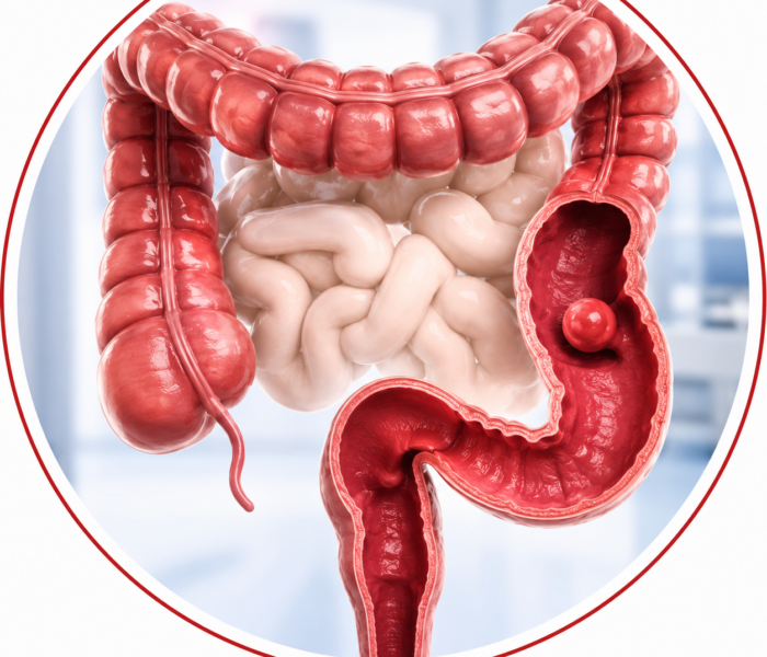Colo-Rectal Surgery
